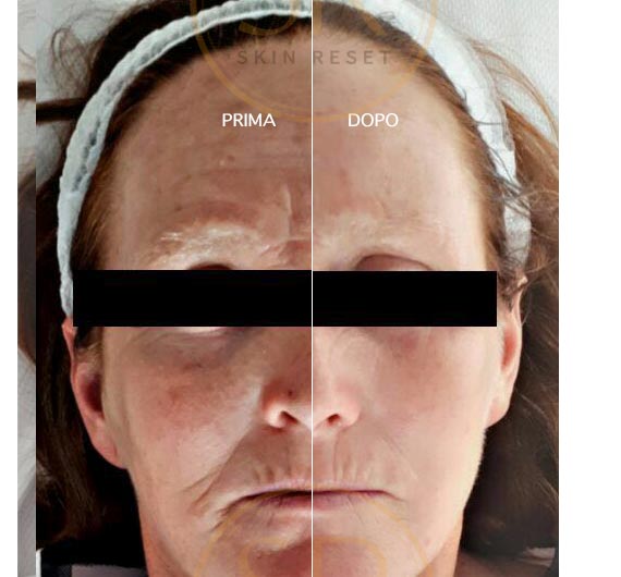 Skin Reset, trattamento viso prima e dopo