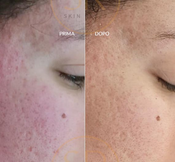 Skin Reset, trattamento viso prima e dopo